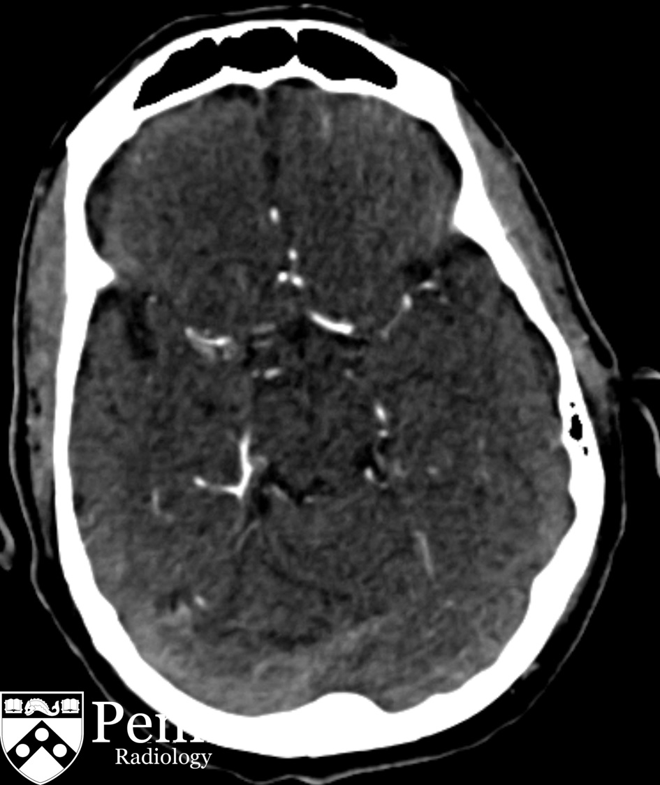 65-year-old-man-with-aphasia