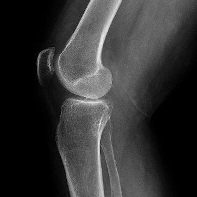 66-year-old woman with knee pain