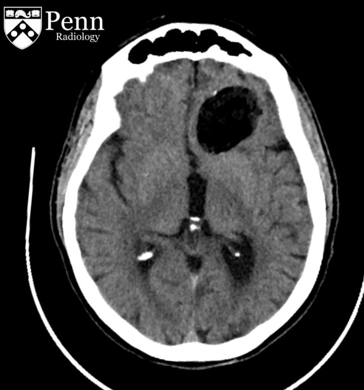 62-year-old-man-with-head-trauma