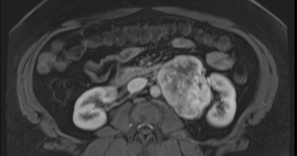 38-year-old-woman-with-hypertension-abdominal-distension