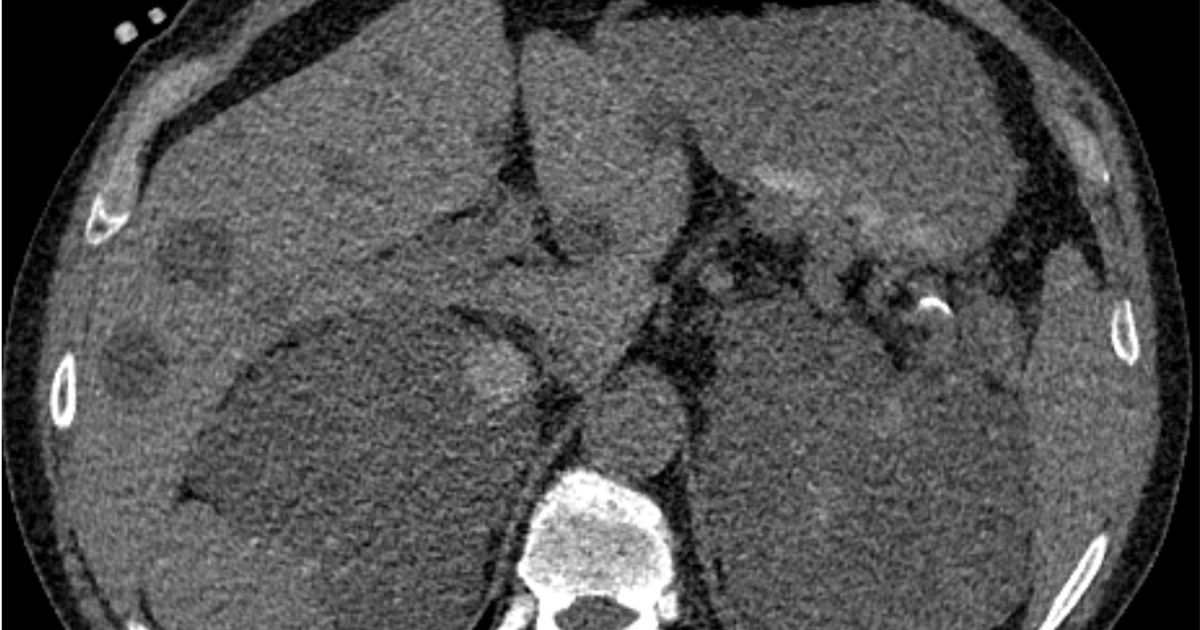 60-year-old-man-with-hematuria-hypertension