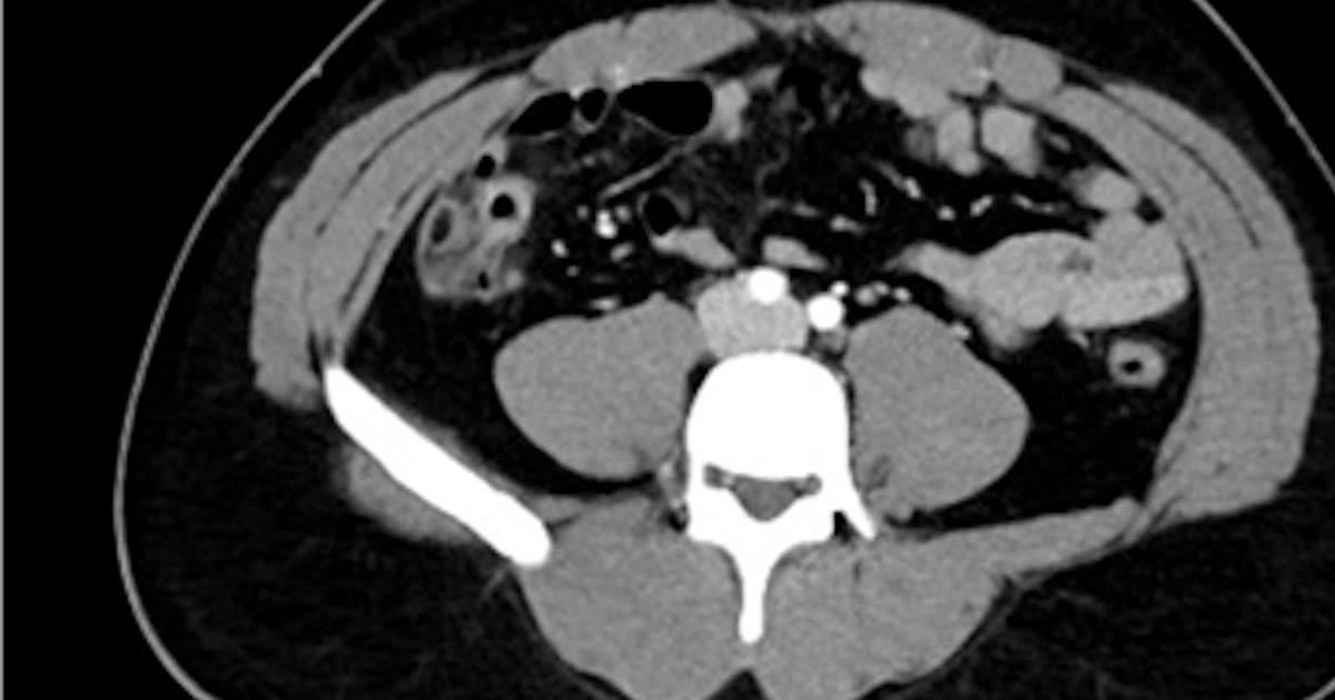 31-year-old-man-with-abdominal-pain