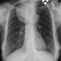 65-year-old woman with mass on chest x-ray